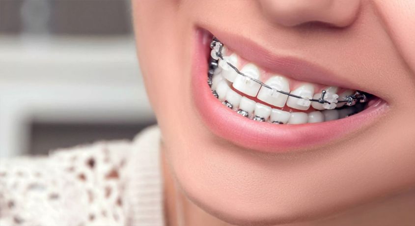 Только сейчас скидка 50% на установку брекетов в стоматологии «DENTARIUM»!