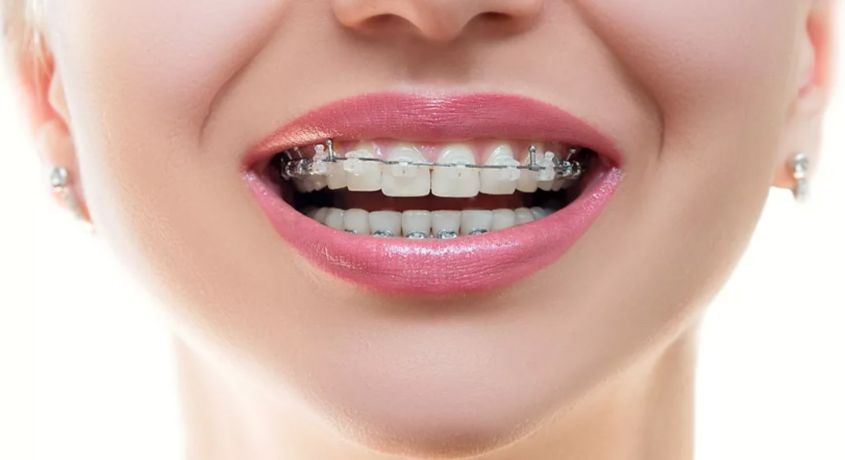 Только сейчас скидка 50% на установку брекетов в стоматологии «DENTARIUM»!