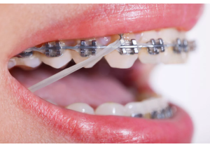 Ортодонтическое лечение с применением самолигирующей брекет системой