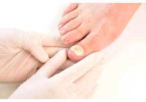 Лечение грибка ногтей на ногах
